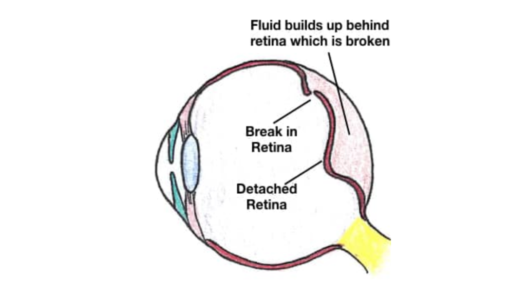 Retina - Dr Bhagat Eye Clinic