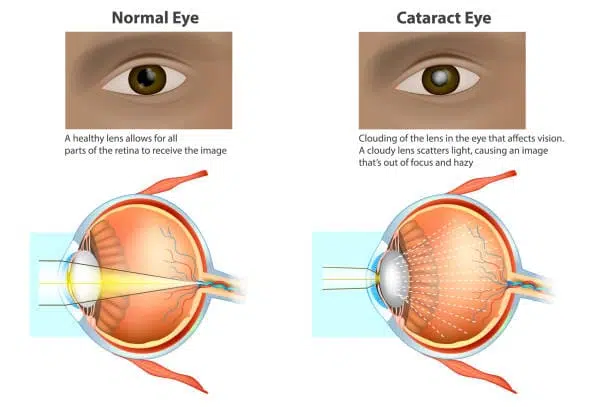 cataract surgery price in borivali