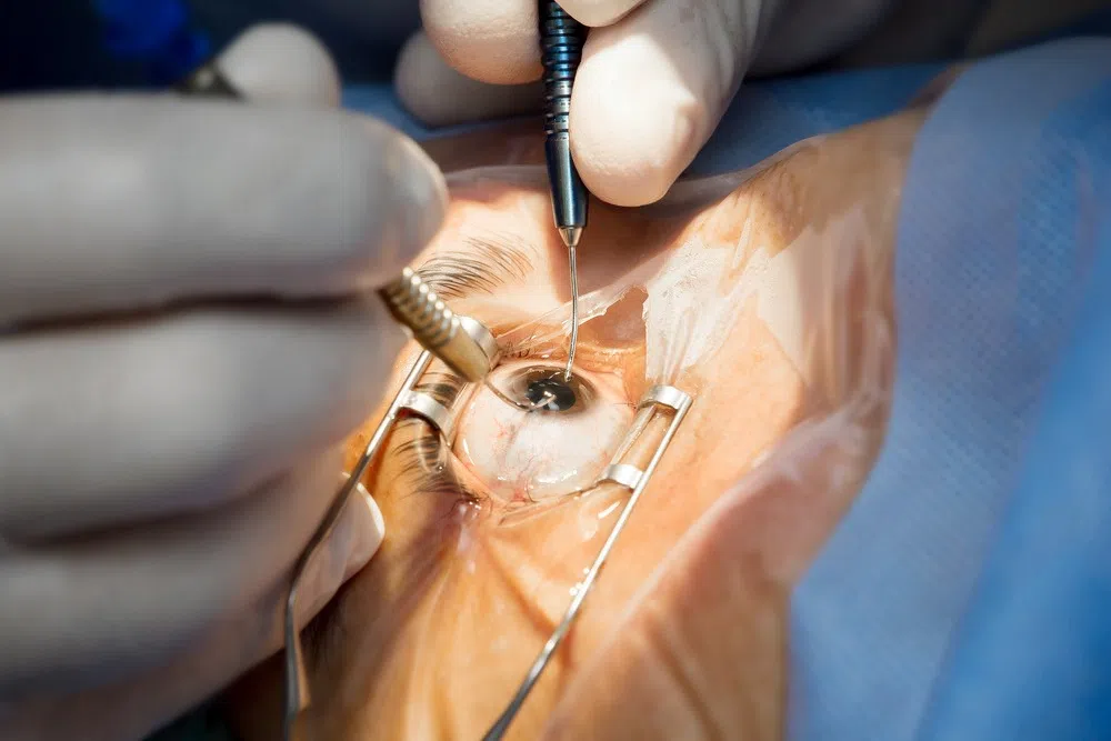phaco surgeries